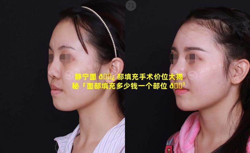 静宁面 🌿 部填充手术价位大揭秘「面部填充多少钱一个部位 🌹 」